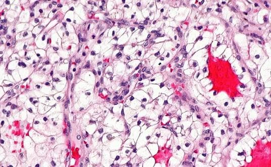 Carcinoma de células renal de tipo células claras