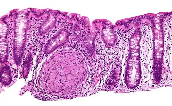 Biopsia del colon de un paciente con enfermedad de Crohn