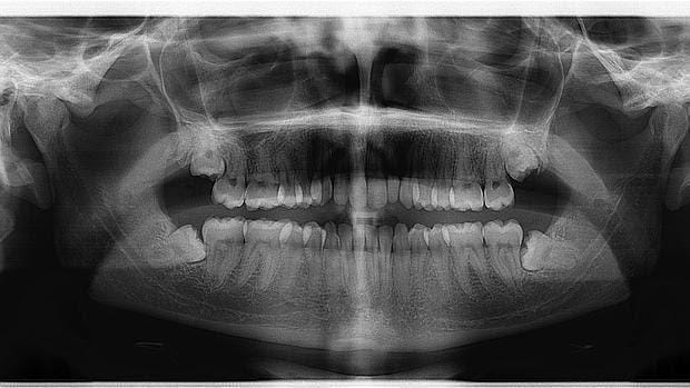 La periodontitis es la primera causa de pérdida de piezas dentales en adultos