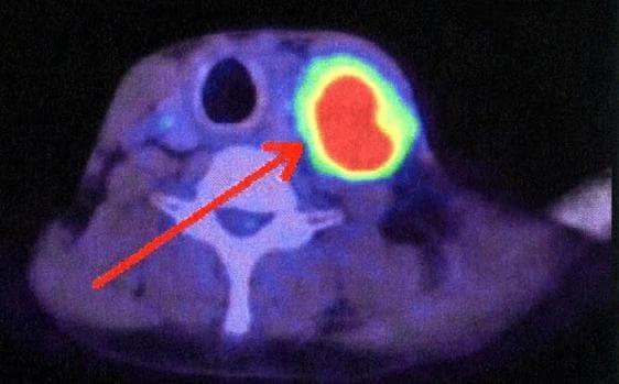 Imagen por PET de metástasis tumoral en un ganglio linfático