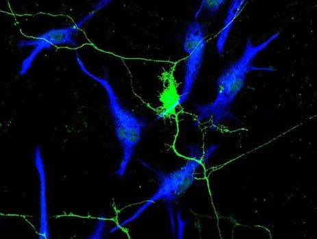 Células del glioma (azul) crecienciendo en torno a las neuronas (verde)