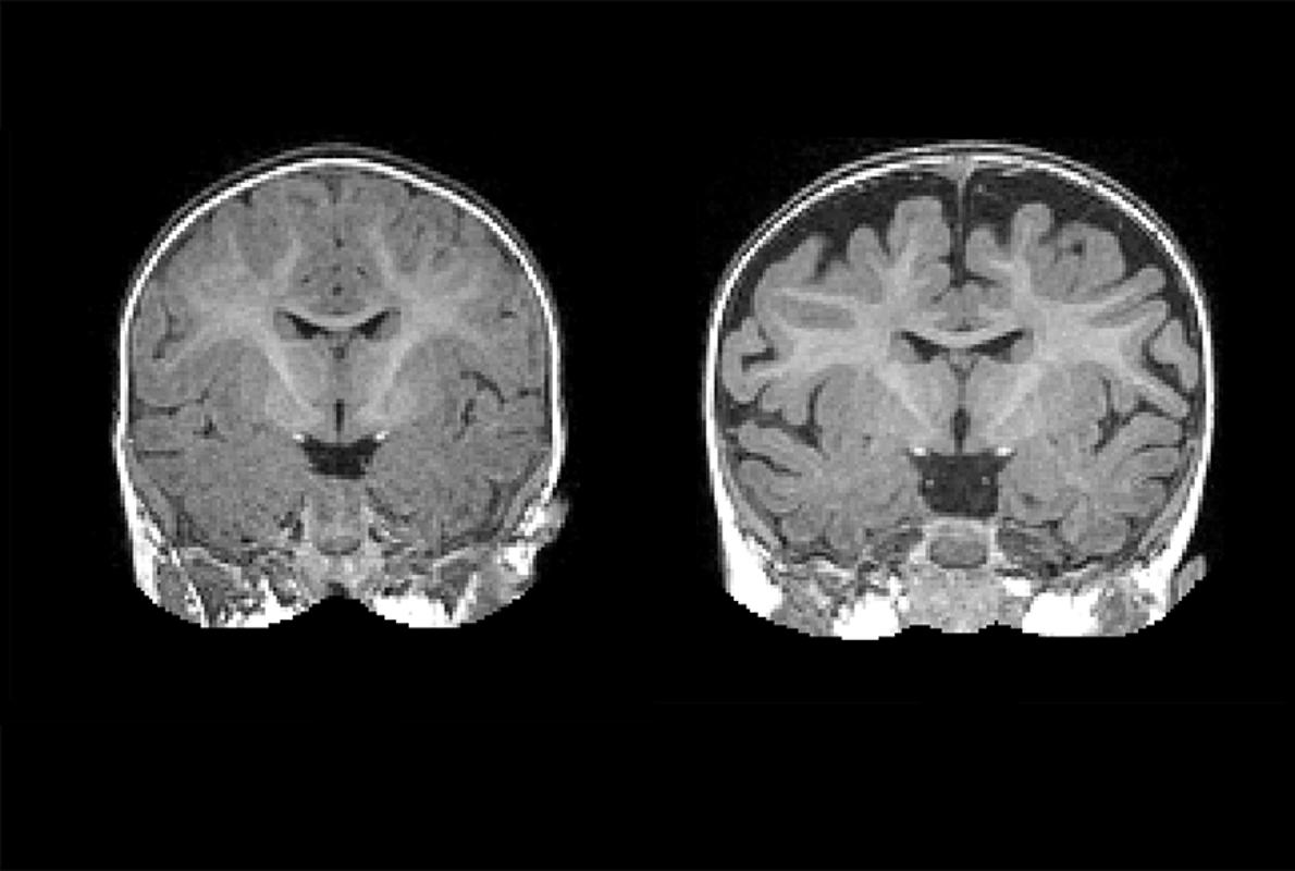 Resonancia magnética puede sde un bebé de 6 meses diagnosticado de TEA a los 2 años (dcha), y un cerebro de un bebñe sin autismo (izda).