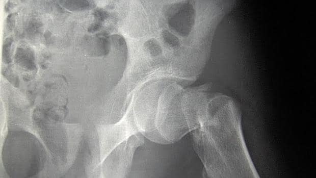 Radiografía de una fractura de cadera