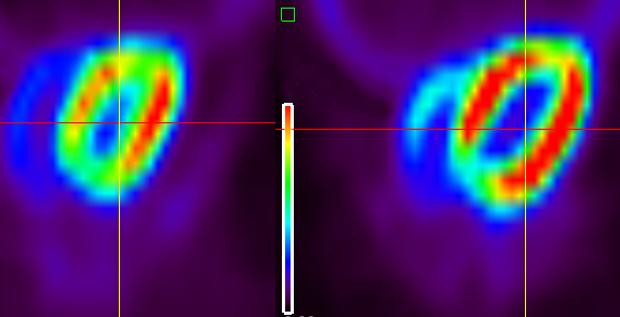 Imágenes de tomografía por emisión de positrones (PET) mostrando actividad cardiaca incrementada (rojo) en ratones con niveles deficientes en Plk1 (derecha) en comparación con ratones normales (izquierda