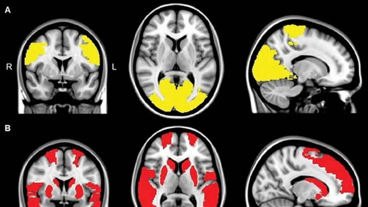 Disminución de la conectividad en los lóbulos paracentral y occipital en pacientes con alucinaciones visuales (abajo)