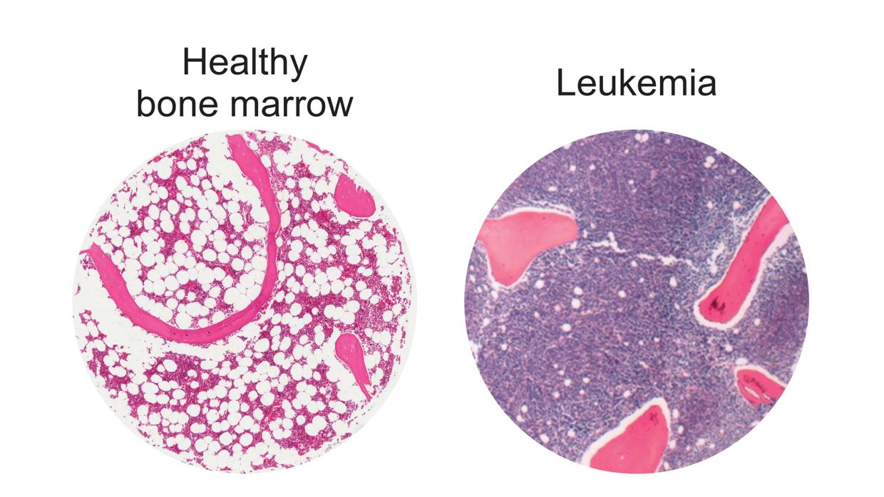 Células grasas (círculos blancos) en médula ósea humana sana, izquierda, en comparación con la médula ósea en un paciente con leucemia, derecha