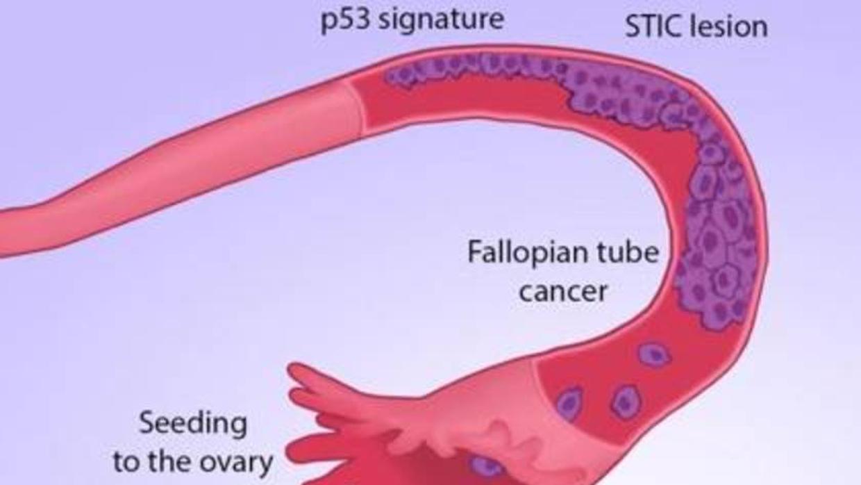 Origen y desarrollo del cáncer de ovario