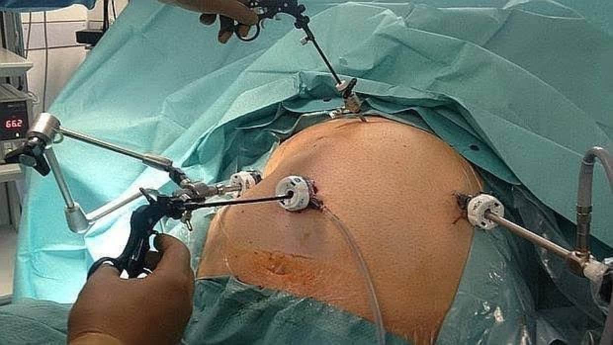 La cirugía bariátrica corrige las ‘deformaciones’ en el corazón causadas por la obesidad