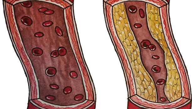 Un estudio con stents coronarios en pacientes con angina de pecho subraya el potencial del efecto placebo