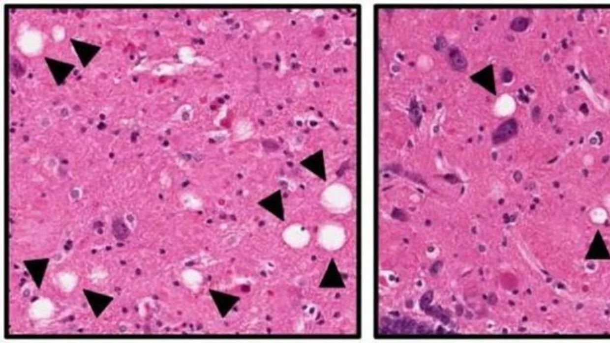 Disminución de muerte neuronal (en blanco) con el fármaco experimental (izquierda)