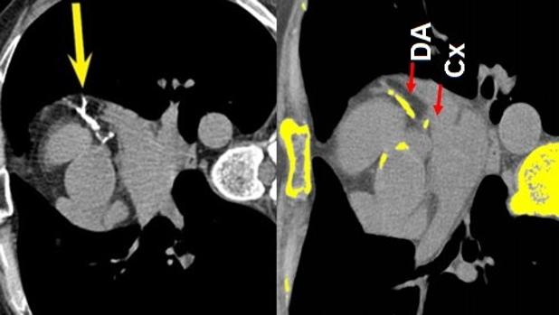 El colesterol 'malo' es el principal predictor de aterosclerosis en personas sanas, tras la edad y el sexo