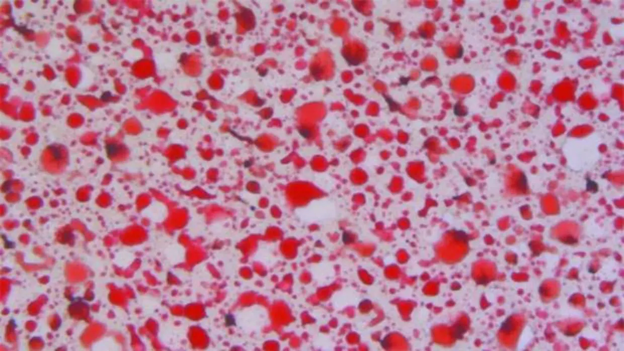 La acumulación de lípidos (en rojo) promueve el desarrollo del carcinoma hepatocelular