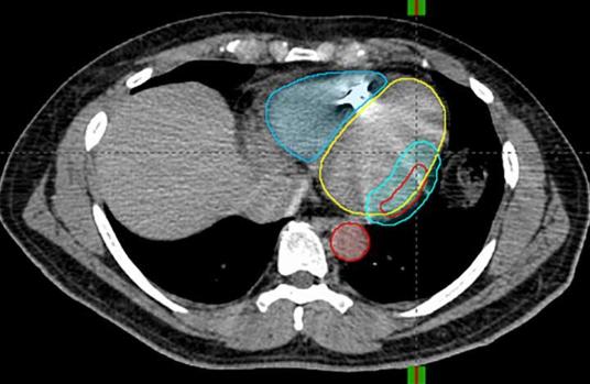 Demostrada la eficacia de la radioterapia para el tratamiento de la arritmia más letal