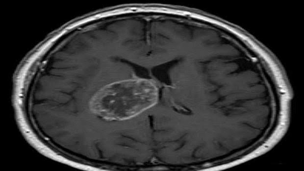 Nueva terapia capaz de prolongar la supervivencia en el tumor cerebral más común