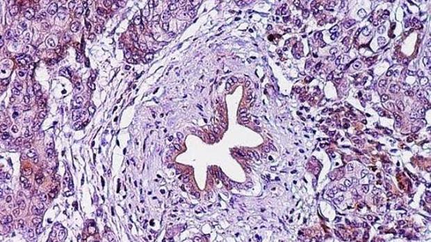 Infectar a las células tumorales de gripe podría ser la clave para vencer al cáncer de páncreas