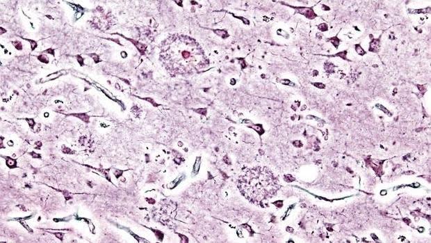 La THS en la menopausia podría proteger frente al alzhéimer