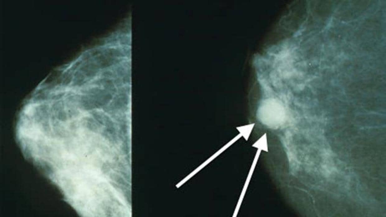 La doble mastectomía preventiva reduce el riesgo de muerte en cáncer de mama BRCA1