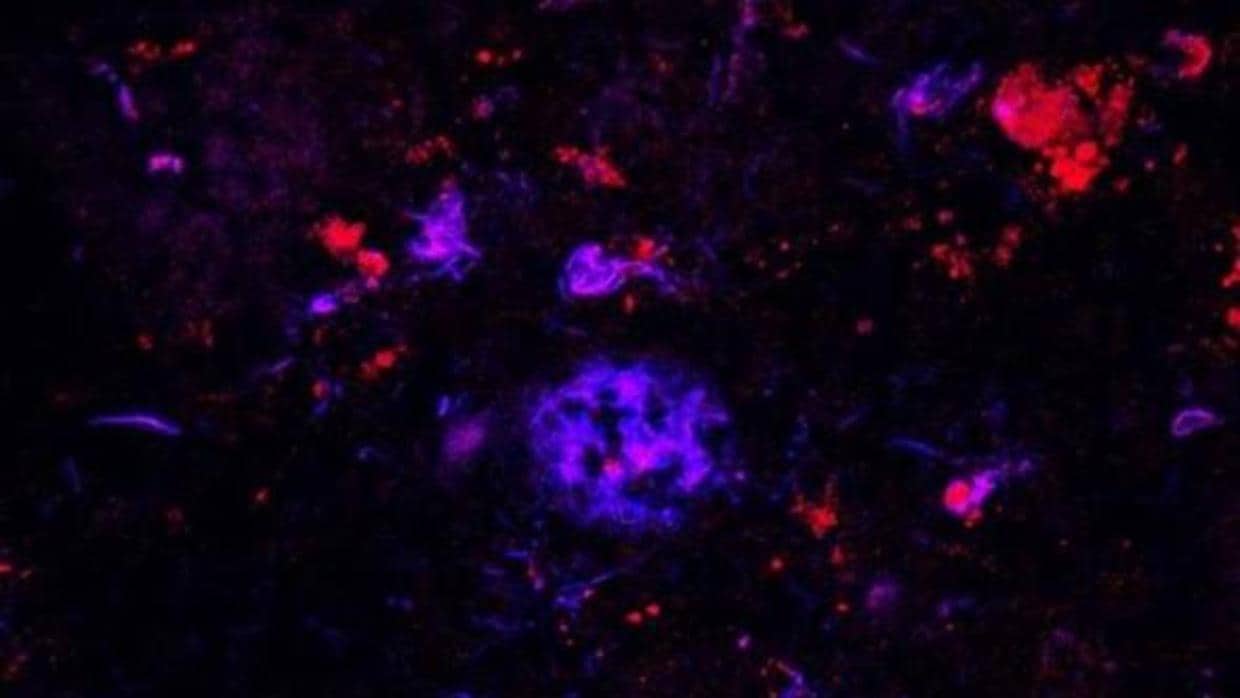 Unión de anticuerpos frente a ApoE (en rojo) a las placas de beta-amiloide (en azul) en el tejido cerebral de un paciente con alzhéimer