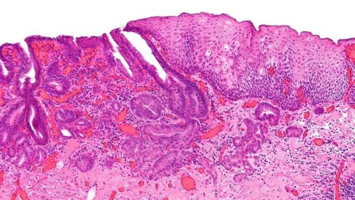 El de esófago es el sexto tipo de tumor que más muertes causa cada año en todo el mundo