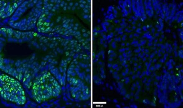 Hallan cómo lograr que las células de cáncer de próstata agoten su energía y mueran