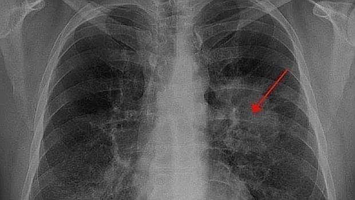 Radiografía de un paciente con cáncer de pulmón