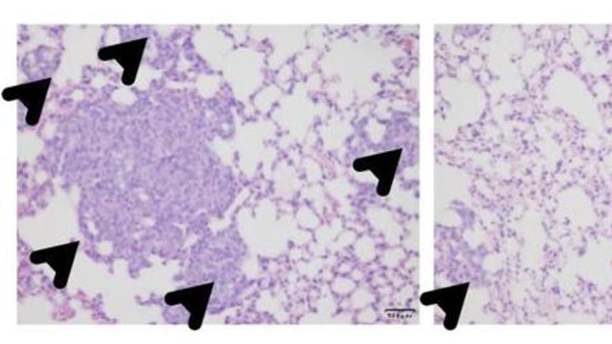 Supresión de tumores metastásico en el pulmón de ratones tratados con ácido zoledrónico (derecha)