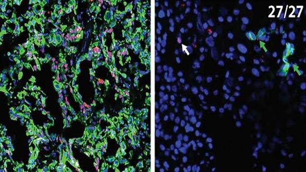 Hallan cómo prevenir las metástasis del cáncer de páncreas tras la cirugía