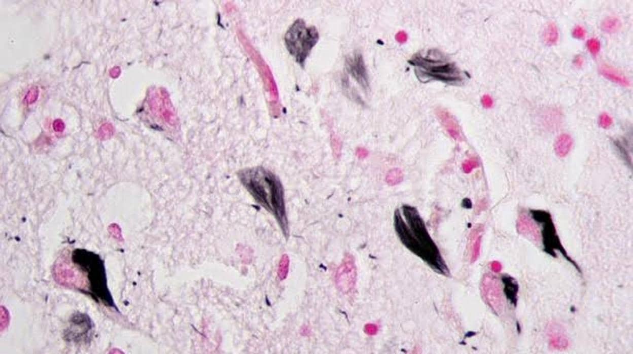 Ovillos neurofibrilares de proteína tau en el hipocampo de un paciente con alzhéimer