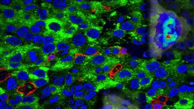 Diana terapéutica clave para el abordaje de los tumores cerebrales