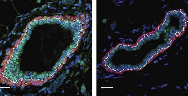 Fármacos inhibidores epigenéticos para prevenir el cáncer de mama