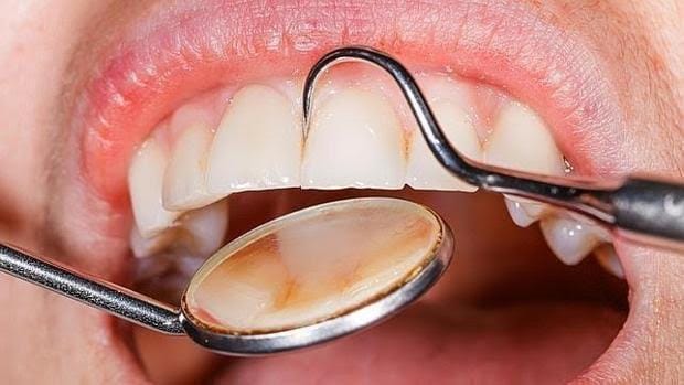 La periodontitis también provoca hipertensión