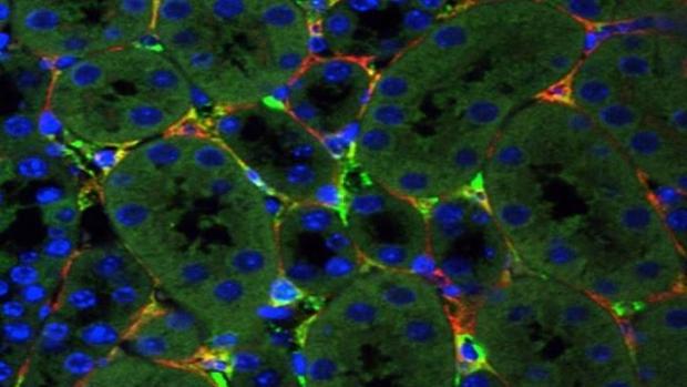 Primer paso para la terapia génica en la insuficiencia renal