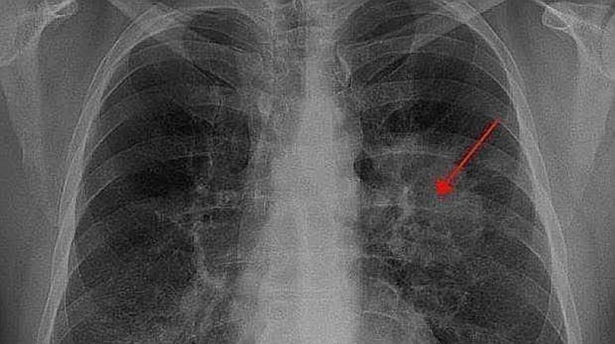 Radiografía de un paciente con cáncer de pulmón