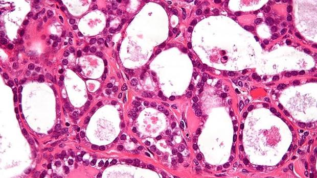 Los nuevos anticonceptivos orales mantienen el efecto protector ante el cáncer de ovario