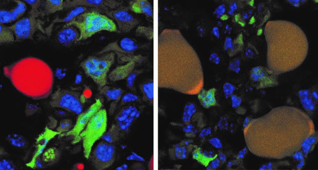 Adiós a la metástasis: engañan a las células tumorales para que se conviertan en grasa