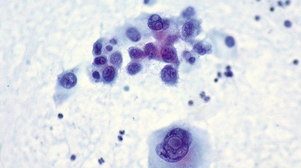 Nueva opción terapéutica prometedora para tratar el melanoma mutante NRAS