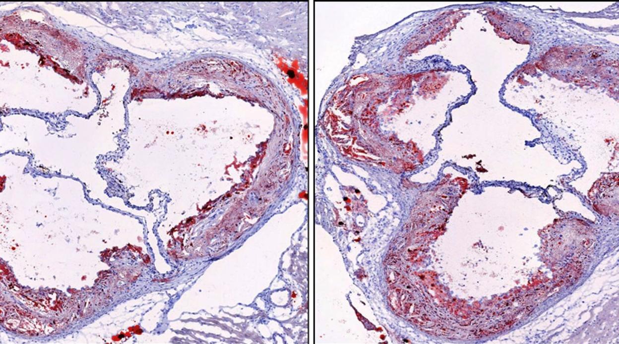 Imágenes de placa de la arteria de un modelo de aterosclerosis de ratón que experimentó un patrón de sueño normal (izquierda) y una imagen de placa arterial de un modelo de ratón que sufrió fragmentación del sueño (derecha). La cantidad de placa arterial en el ratón fragmentado del sueño es significativamente mayor.