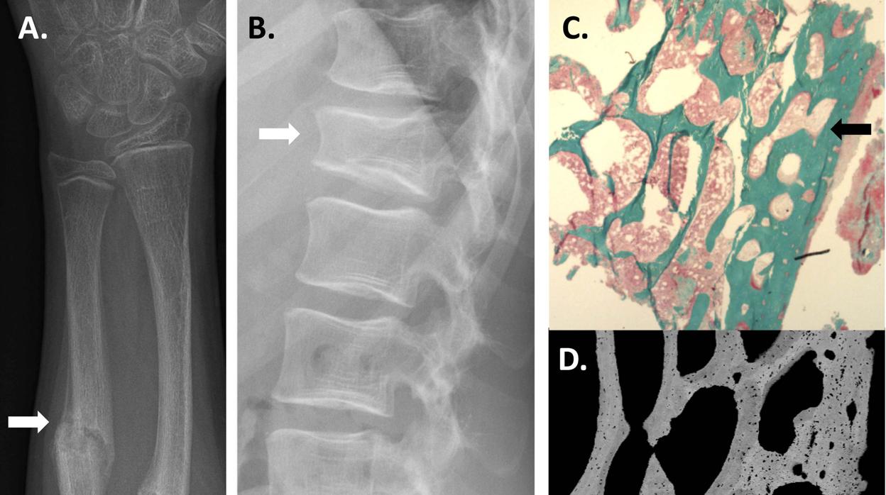 Pie de foto: La salud ósea de los participantes del estudio se evaluó mediante radiografías (A, B) y muestras de biopsia ósea (C, D). Los pacientes tuvieron en la infancia por ej. Fracturas recurrentes de antebrazo (A) y fracturas de compresión espinal (B). La evaluación histológica de las biopsias óseas mostró (C) que la estructura ósea (verde), especialmente en el hueso cortical, era anormalmente frágil y osteoporótica. Una evaluación más detallada de las biopsias óseas mostró que el grado de mineralización ósea se redujo y el tejido óseo era poroso (D), lo que redujo la resistencia ósea