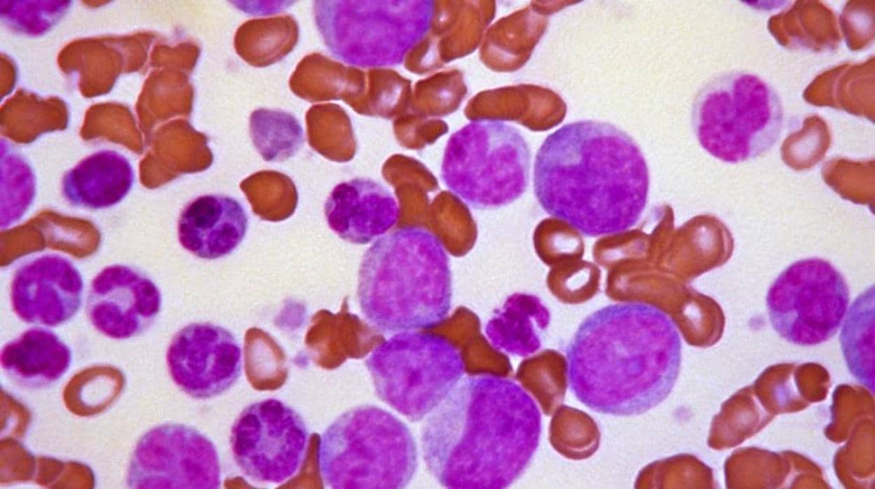 Células de leucemia