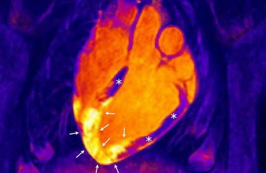 Investigadores españoles aspiran a cambiar el tratamiento tras un infarto