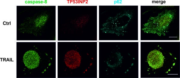 Un nuevo biomarcador acerca los tratamientos personalizados contra el cáncer