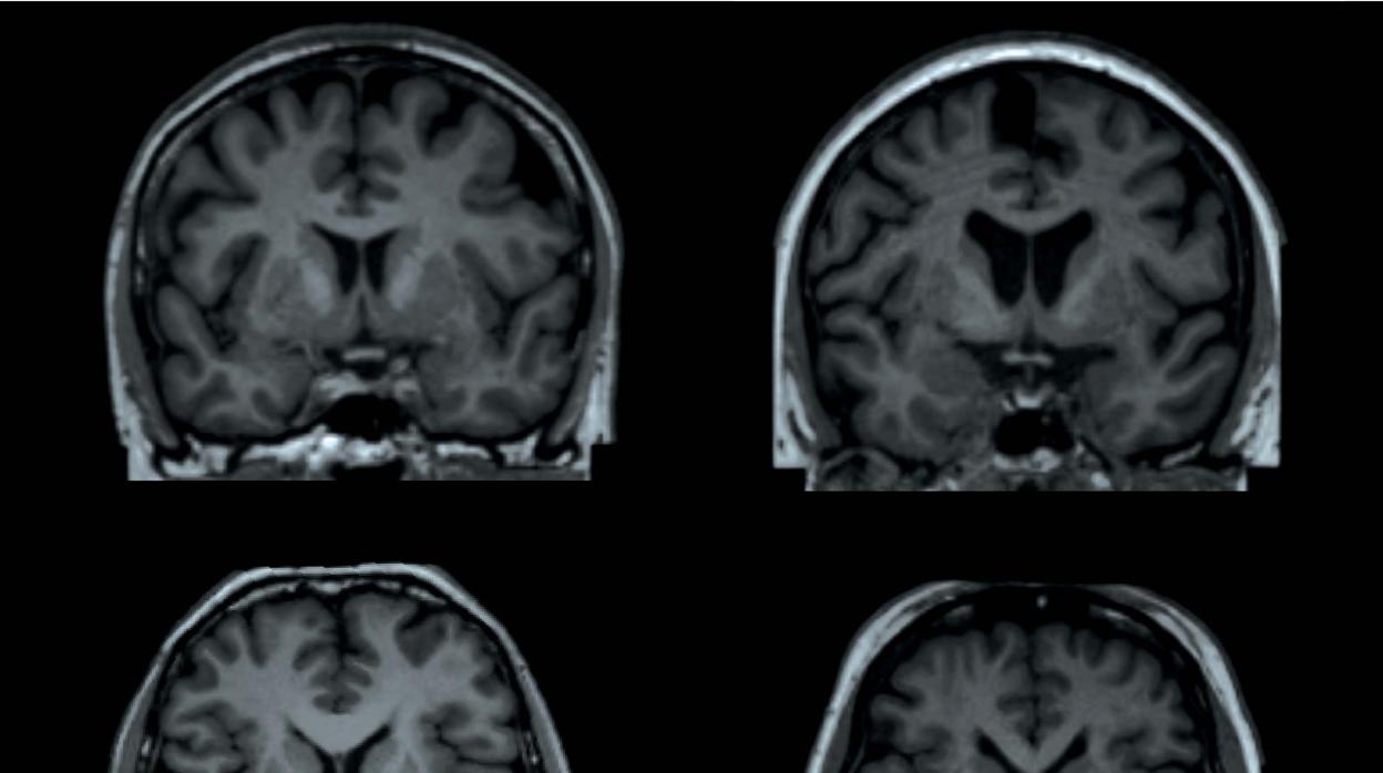 La obesidad nos transforma la forma del cerebro