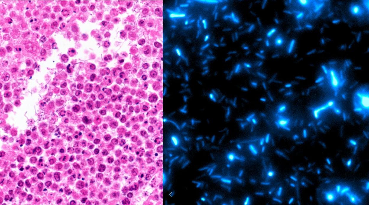 Imagen histológica de bacterias que crecen en regiones necróticas de tumores de linfoma (IZQUIERDA). Las bacterias están programadas para sufrir oleadas de crecimiento y autodestrucción que conducen a la liberación inmunoterapéutica (DERECHA).