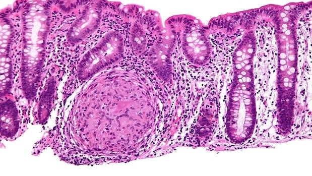 La terapia combinada dirigida mejora la supervivencia en pacientes con cáncer colorrectal avanzado