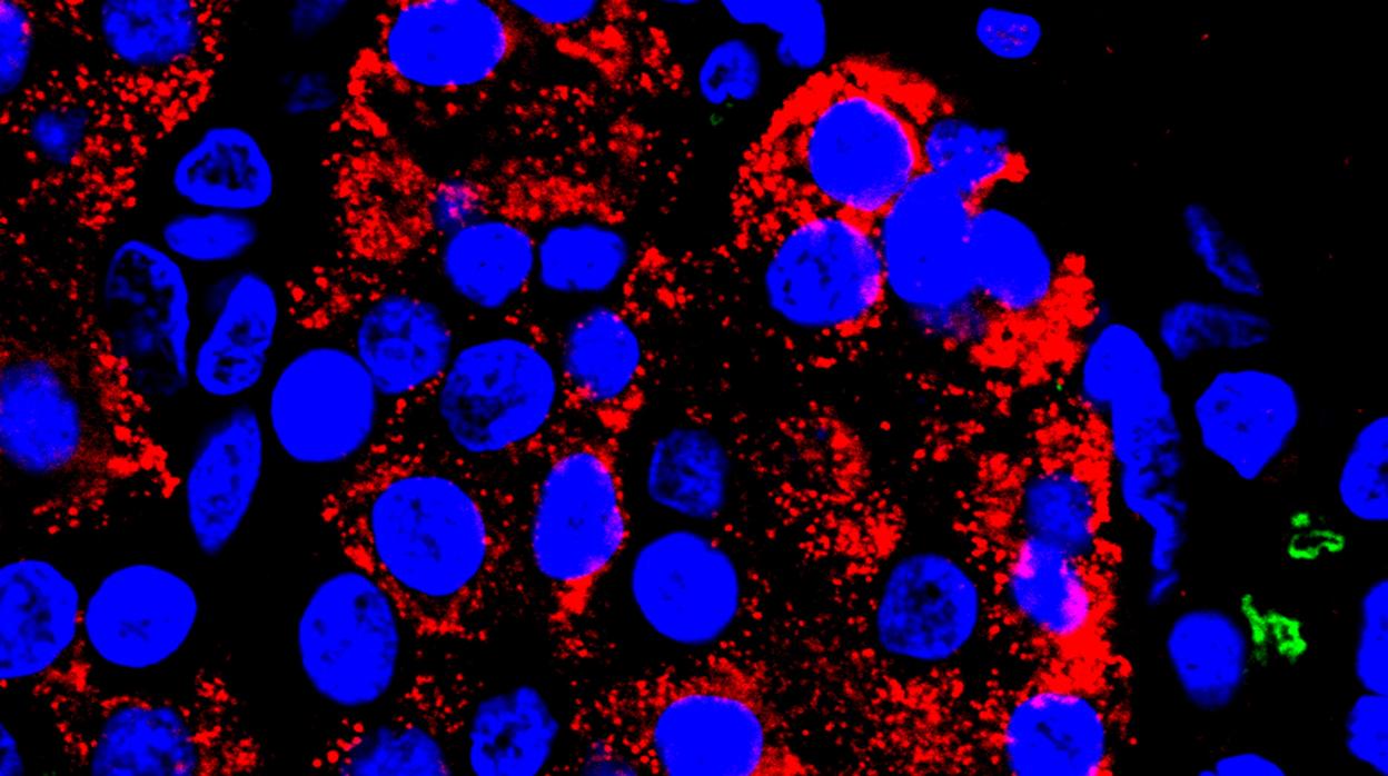 Esta imagen microscópica muestra células pancreáticas humanas codificadas por colores para mostrar la presencia de insulina y el gen CFTR (regulador de conductancia transmembrana de la fibrosis quística.