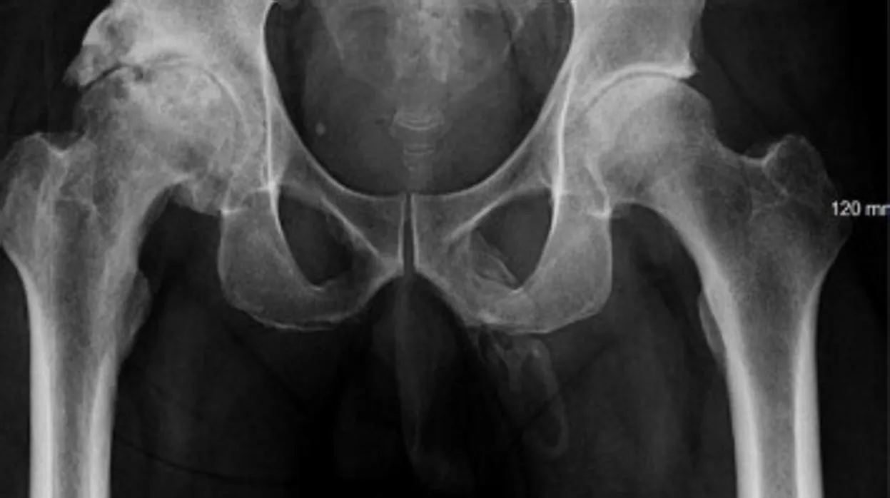 Radiografía que descubrió la osificación del pene de este paciente