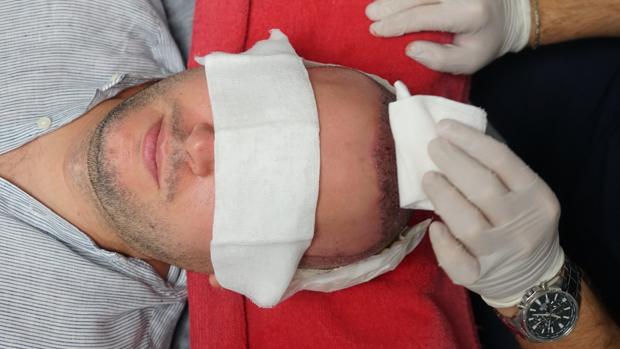Viajar a Turquía y recuperar el pelo que tenía a los 17 (II): así es la operación de un trasplante capilar