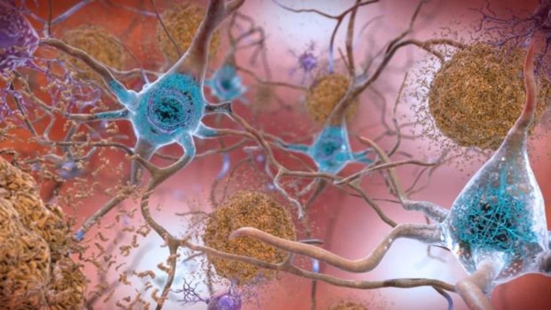 Cerebro afectada por alzhéimer