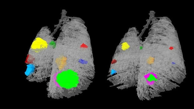 Una terapia combinada para el cáncer de pulmón más mortal