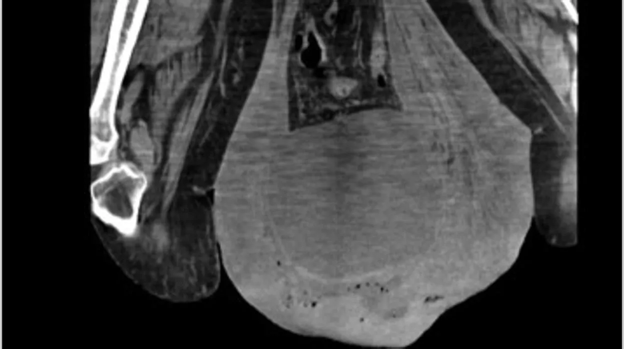 La imagen que ilustra el impresionante edema escrotal y una hernia inguinal masiva